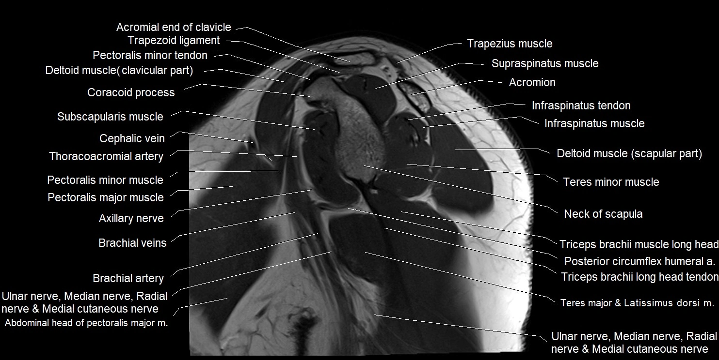 mri shoulder sagittal cross sectional anatomy image 6.webp